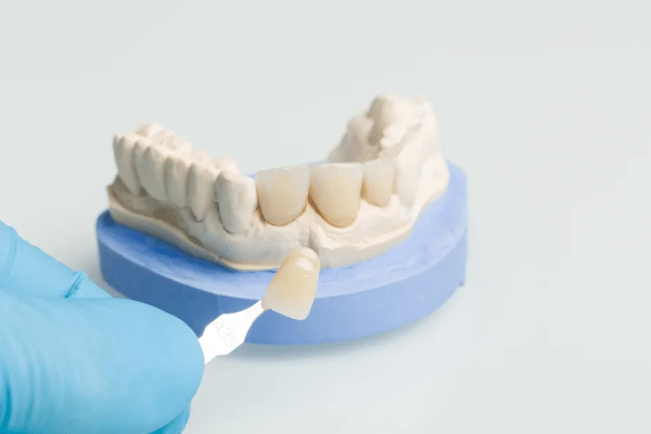 faccetta dentale