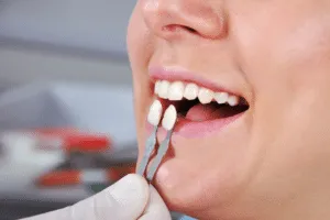 faccette dentali denti storti