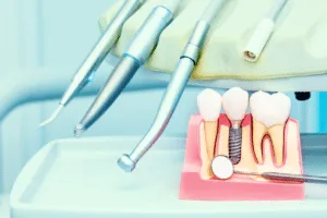 implantologia dentale roma