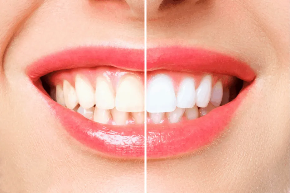 sbiancamento dentale professionale